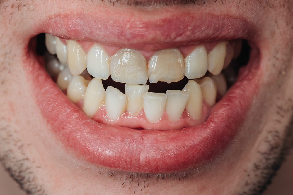 8 Dream of A Chipped Tooth Meanings