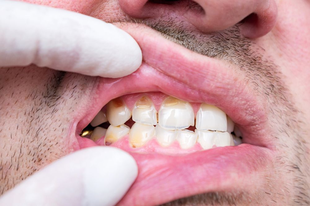 8 Dream of A Chipped Tooth Meanings2